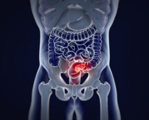 colorectal cancer.