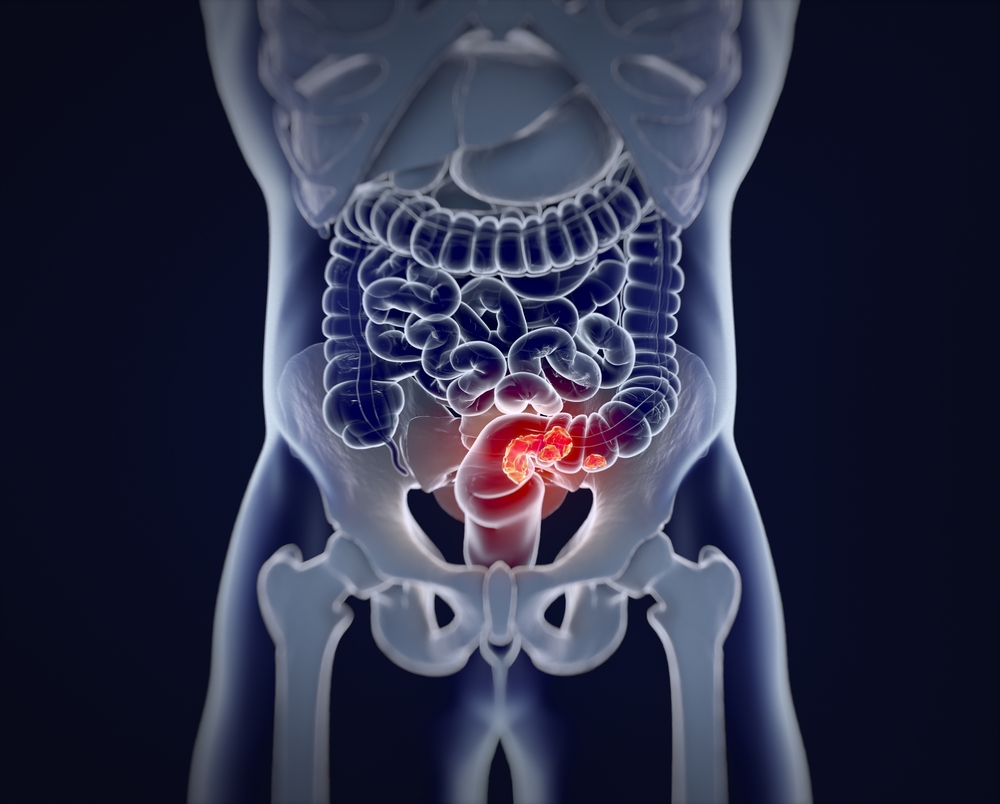 colorectal cancer.
